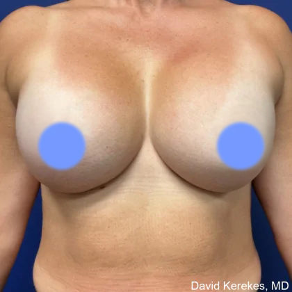 Breast Augmentation Before & After Patient #4849