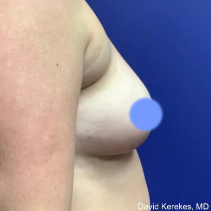 Breast Augmentation Before & After Patient #4849