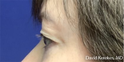 Eye Lift Before & After Patient #4829
