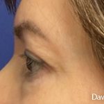 Eye Lift Before & After Patient #4829