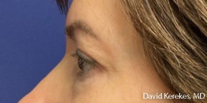 Eye Lift Before & After Patient #4829