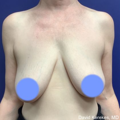 Breast Lift Before & After Patient #4814