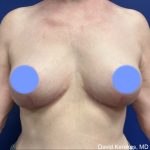 Breast Lift Before & After Patient #4814