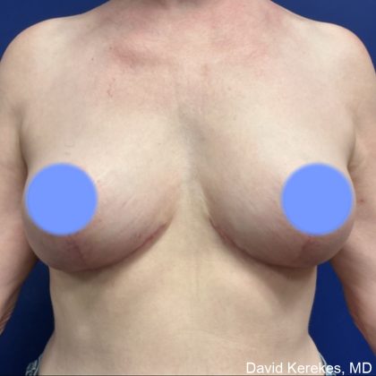 Breast Lift Before & After Patient #4814