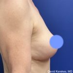 Breast Lift Before & After Patient #4814