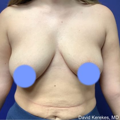 Breast Lift Before & After Patient #4816