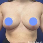 Breast Lift Before & After Patient #4816