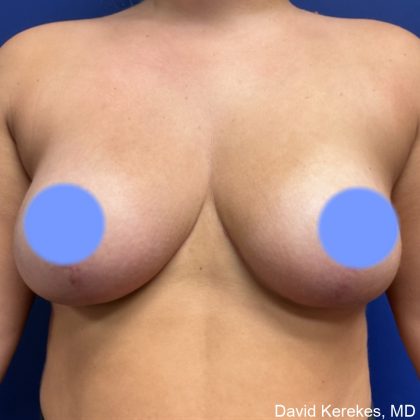 Breast Reduction Before & After Patient #4815