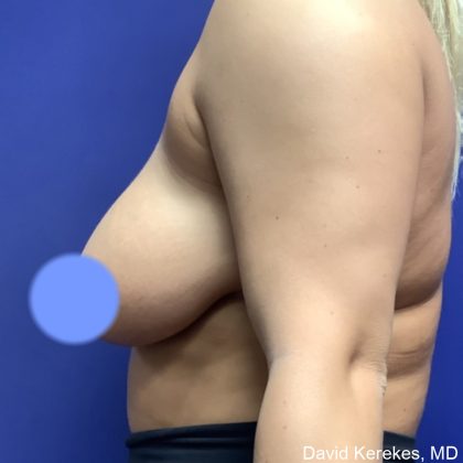 Breast Reduction Before & After Patient #4815