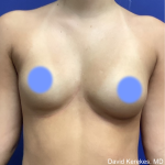 Breast Augmentation Before & After Patient #4872