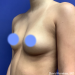 Breast Augmentation Before & After Patient #4872