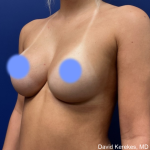 Breast Augmentation Before & After Patient #4872