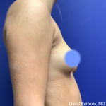 Breast Augmentation Before & After Patient #4872