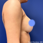 Breast Augmentation Before & After Patient #4872