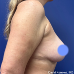 Breast Lift Before & After Patient #4973