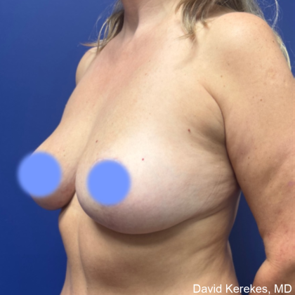 Breast Lift Before & After Patient #4973