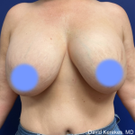 Cosmetic Breast Revisions Before & After Patient #5017