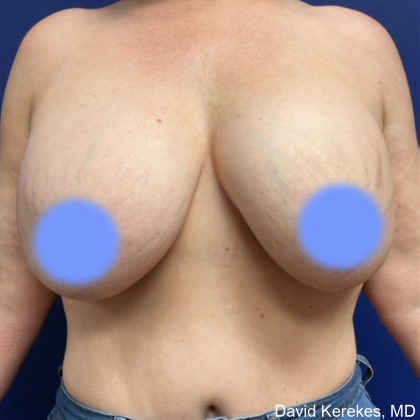 Cosmetic Breast Revisions Before & After Patient #5017