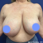 Breast Reduction Before & After Patient #5008