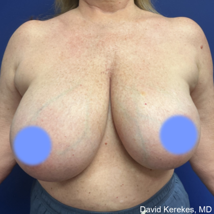 Breast Reduction Before & After Patient #5008