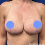 Breast Lift Before & After Patient #4989