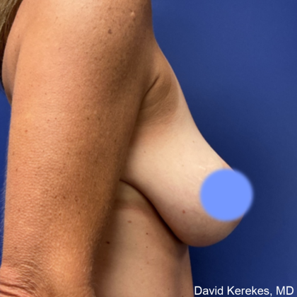 Breast Lift Before & After Patient #4989