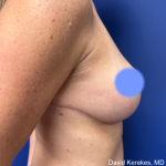 Breast Lift Before & After Patient #4989