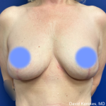Cosmetic Breast Revisions Before & After Patient #5017