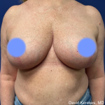 Breast Reduction Before & After Patient #5008