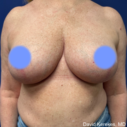 Breast Reduction Before & After Patient #5008