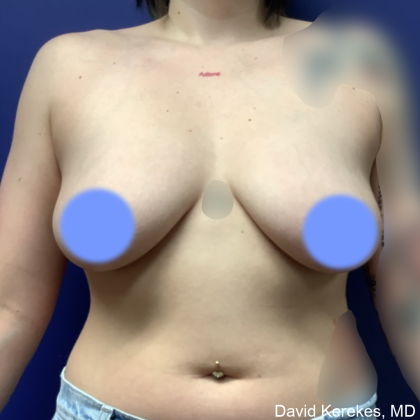 Breast Lift Before & After Patient #4990