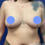 Breast Lift Before & After Patient #4990