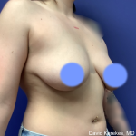 Breast Lift Before & After Patient #4990