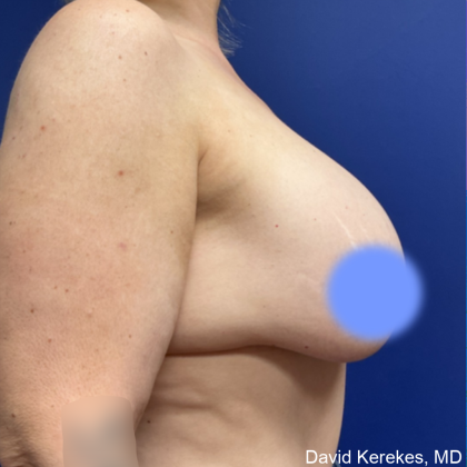 Cosmetic Breast Revisions Before & After Patient #5017