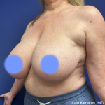 Breast Reduction Before & After Patient #5008