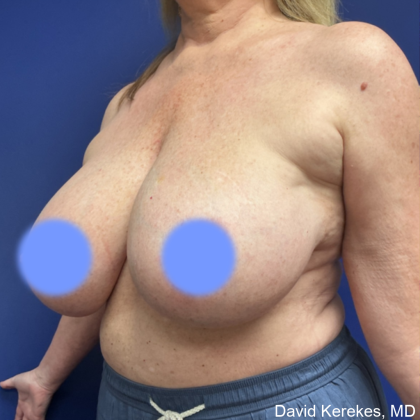 Breast Reduction Before & After Patient #5008