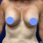 Cosmetic Breast Revisions Before & After Patient #4991