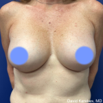 Cosmetic Breast Revisions Before & After Patient #4991