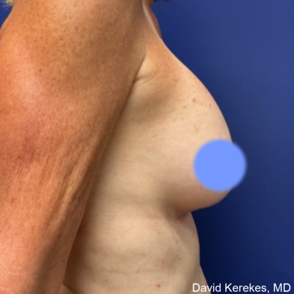 Cosmetic Breast Revisions Before & After Patient #4991