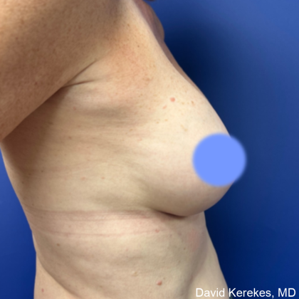Cosmetic Breast Revisions Before & After Patient #4991