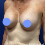Cosmetic Breast Revisions Before & After Patient #4991
