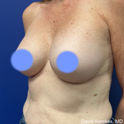 Cosmetic Breast Revisions Before & After Patient #4991