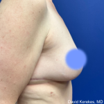 Cosmetic Breast Revisions Before & After Patient #5017