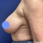 Breast Reduction Before & After Patient #5008