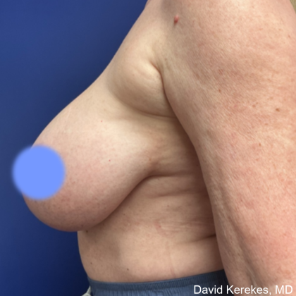 Breast Reduction Before & After Patient #5008