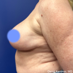 Breast Reduction Before & After Patient #5008