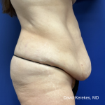 Tummy Tuck Before & After Patient #5065