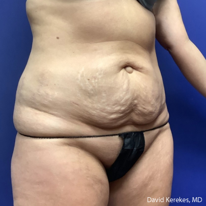 Tummy Tuck Before & After Patient #5031