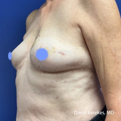 Breast Reconstruction Before & After Patient #5055