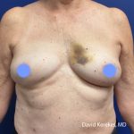 Breast Reconstruction Before & After Patient #5055